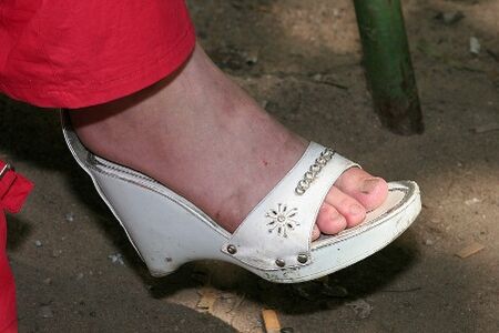 Le manque d'hygiène des pieds est la raison du développement de champignons