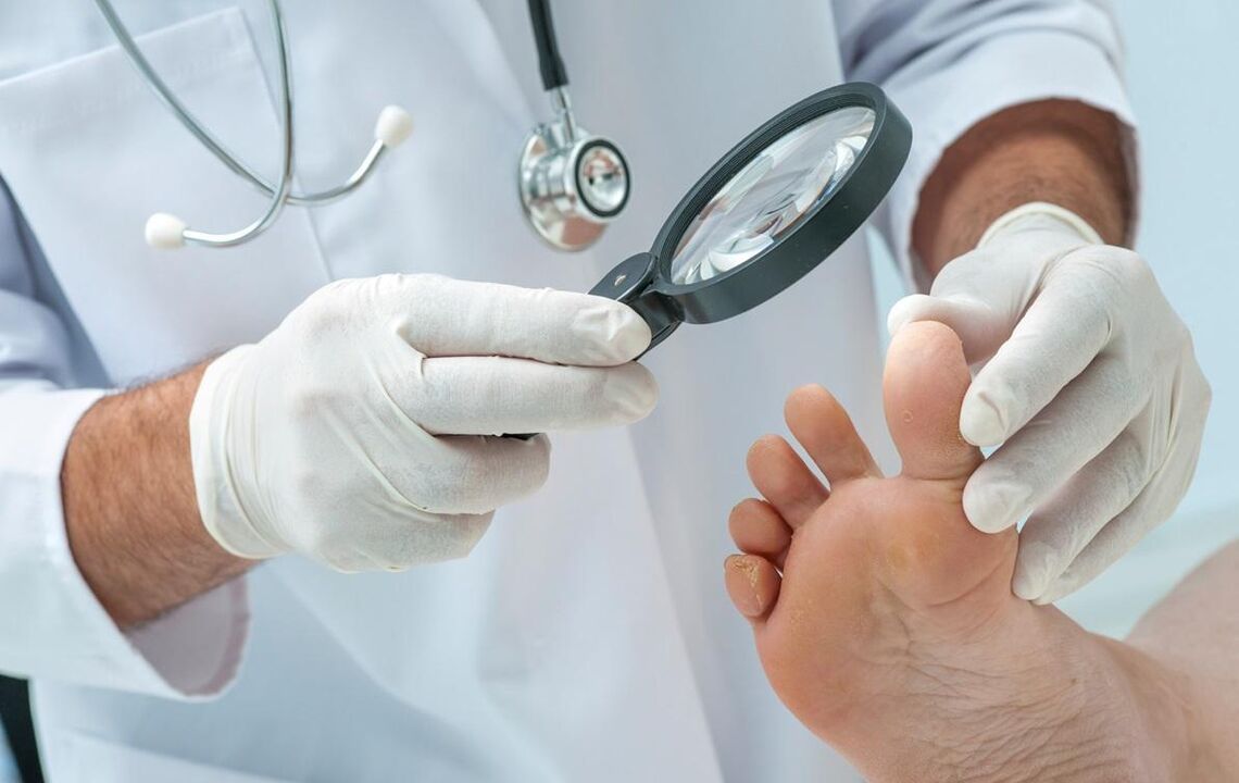 médecin examine les pieds avec des champignons