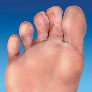 le champignon de la peau des pieds