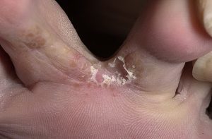 la forme de la mycose des pieds